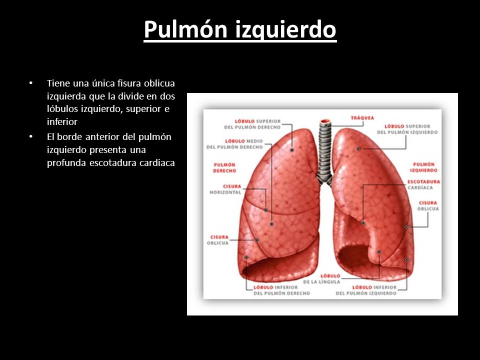 fisura en el pulmon izquierdo